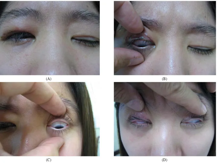 Figure 2. (A) Postoperative view of a patient immediately after suture removal following the third levator resection in the right  eye and the second operation in the left eye showing inverse Bell’s phenomenon on eye closure