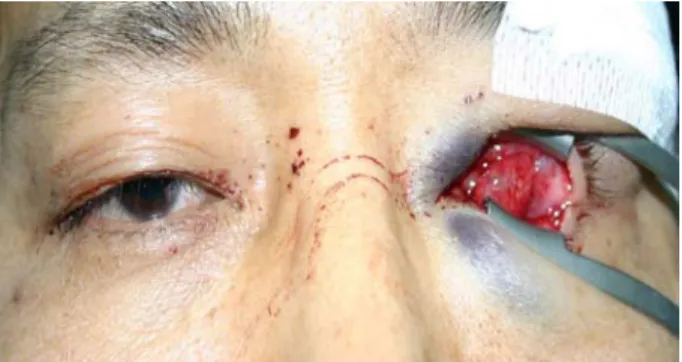 Figure 1. The photograph shows conjunctival edema and no  eyeball in the left orbit.