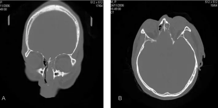 Figure 4. (A) Postoperative CT shows the left globe within the orbit and part of the iliac bone