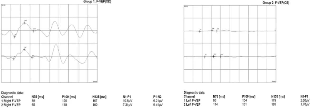 Figure 5. F-VEP shows delayed latency and decreased amplitude in the left eye.