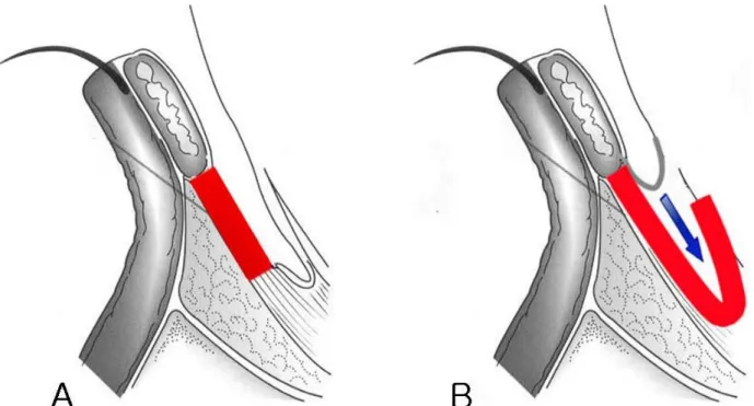 Figure 1. The correction of contracted socket. (A) As a tarsal substitute to elevate the eyelid
