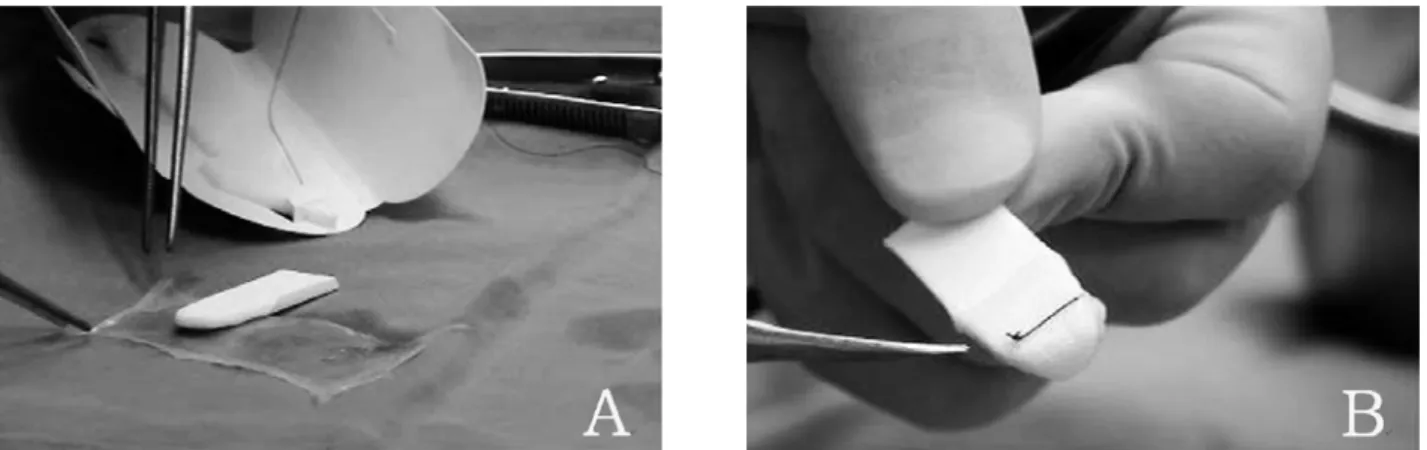 Figure 1. Merocel Ⓡ  was wrapped with amniotic membrane (A) and fixed with 6-0 silk (B).낭비강문합술을  시행받은  60명의  환자  60안을  대상으로  이들  중  30안에  대해서는  수술  후  양막으로  감싼 MerocelⓇ을  비강내  골공에  충전하였고(1군), 나머지 30안에  대해서는  일반적인  MerocelⓇ을  충전하여(2군) 그  결과를  전향적으로  비교  분석하