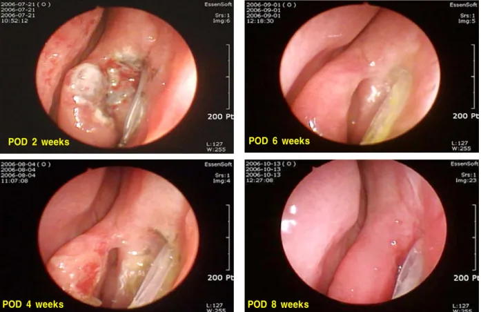 Figure 2. Serial photographs of postoperative wound healing process in group 1. Wound healing was nearly completed at 4  weeks after surgery.