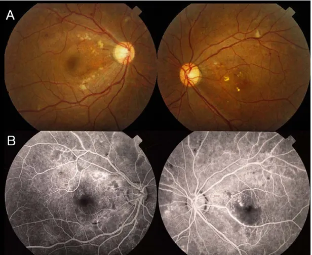 Figure 1. Fundus photographs and fluorescein angiographs at the initial visit. (A) Fundus photographs show multiple cotton-  wool spots and dot-like hemorrhages