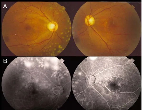 Figure 3. Fundus photographs and fluoresein angiographs at 1 year after the initial visit