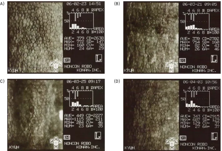 Figure 1. Specular microscopy. (A=preoperative; B=POD #1; C=POD #5; D=POD 1 month)