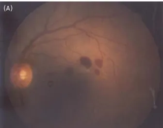 Figure 3. Optical coherence tomography finding after  intraocular lens scleral fixation (1 month postoperatively).
