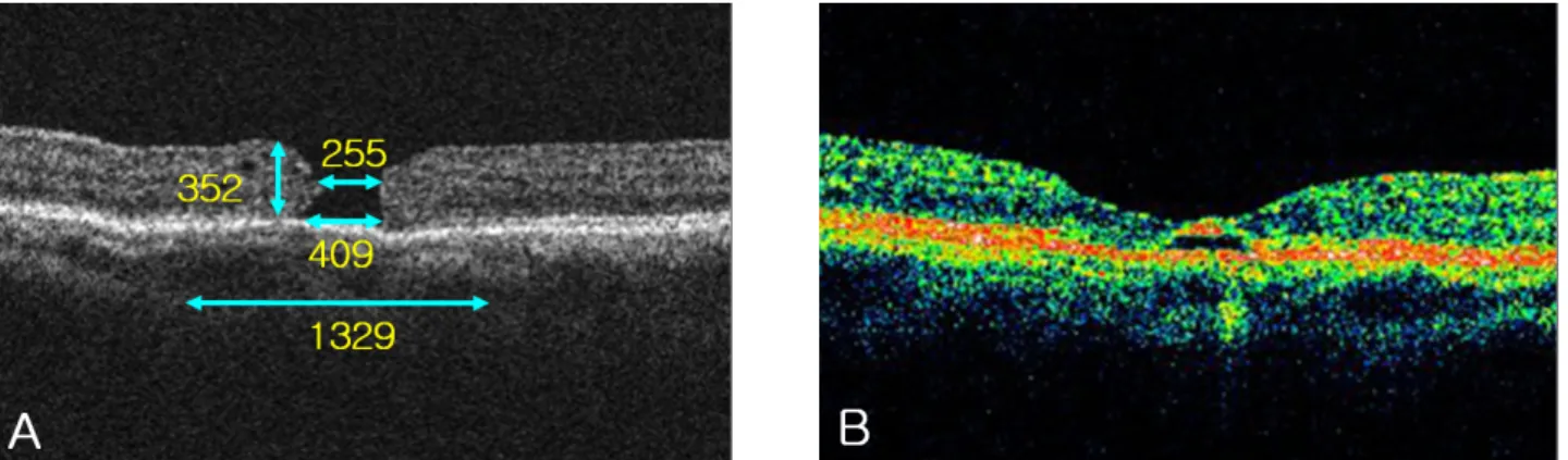 Figure 3. A case of macular hole with low height, high hole form factor (HFF) and macular hole index (MHI)