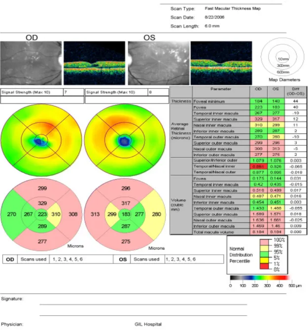 Figure 1. Sample OCT3 display of diabetic macular edema patient with normative data. It displays the macular normative  database information in the form of clinically useful fast macular map and chart