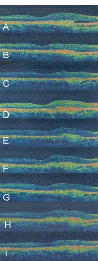 Figure 2. Right eye. Horizontal optical coherence  tomography 6‐mm scans at (A) pretreatment, (B) 1 month,  (C) 3 months, (D) 4 months, at the time of second PDT,  (E) 5 months, (F) 7 months
