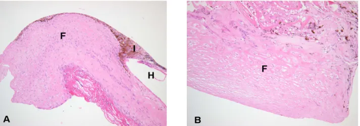 Figure 2. Light microscopy of fibrous membrane shows dense hypocellular fibrous membrane (F) with mild vascularization
