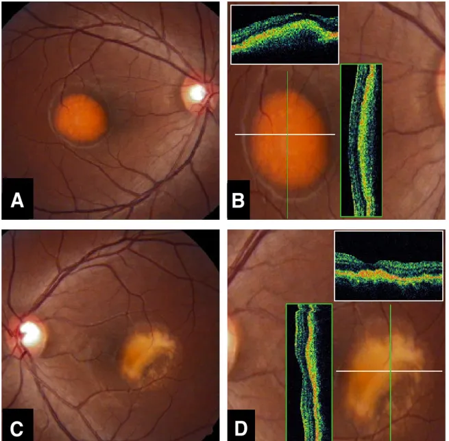 Figure 1. Case 1. Fundus photographs and optical coherence tomography (OCT) findings of the right eye (A, B) and the left eye (C, D) in a patient with Best disease