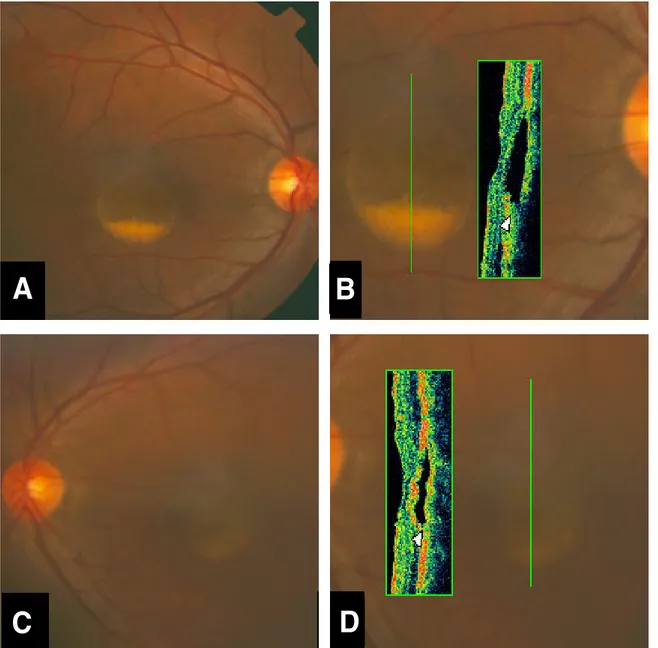 Figure 2. Case 2. Fundus photographs and optical coherence tomography (OCT) findings of the right eye (A, B) and the left eye (C, D) in a patient with Best disease