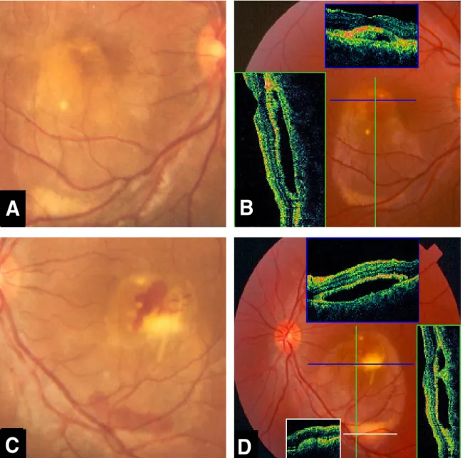 Figure 3. Case 3. Fundus photograph and optical coherence tomography (OCT) findings of the right eye (A, B) and the left eye  (C, D) in a patient with Best disease