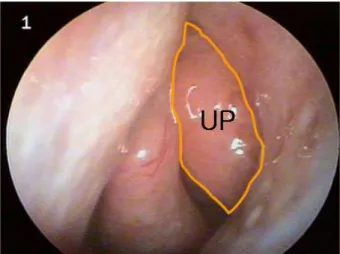 Table 2. Nasal cavity abnormalities