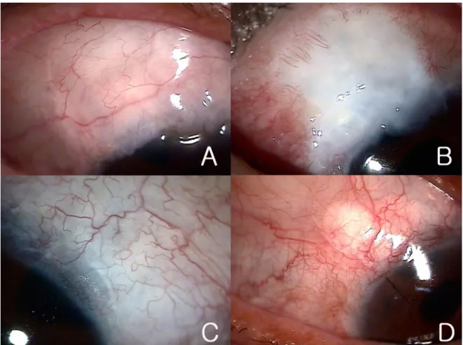 Figure 2. Morphologies of conjunctival blebs. (A) shows a diffuse bleb with microcystic change and (B) shows an ischemic  bleb