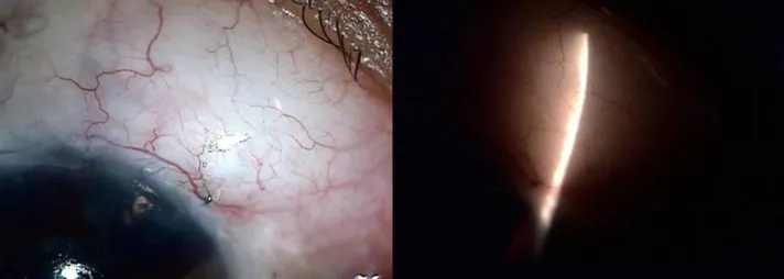 Figure 6. After modified trabeculectomy, there were dome-shaped conjunctival blebs in 14 eyes (54%) of 26 eyes.