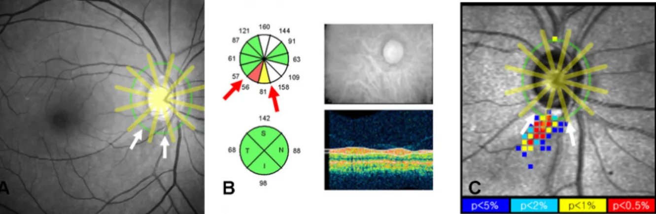 Figure 1. Method to identify a localized retinal nerve fiber layer (RNFL) defect by the Stratus OCT optical coherence  tomography and GDx VCC scanning laser polarimetry with variable corneal compensation