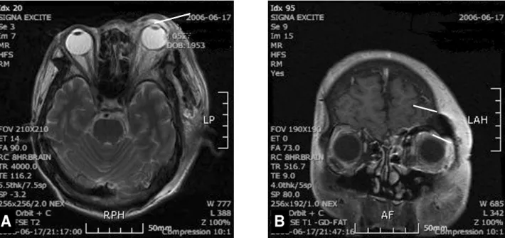 Figure 3. Orbit MRI showed ill defined increased signal density in T2-weighted image (A) and T1-weighted image (B) in the  left orbit