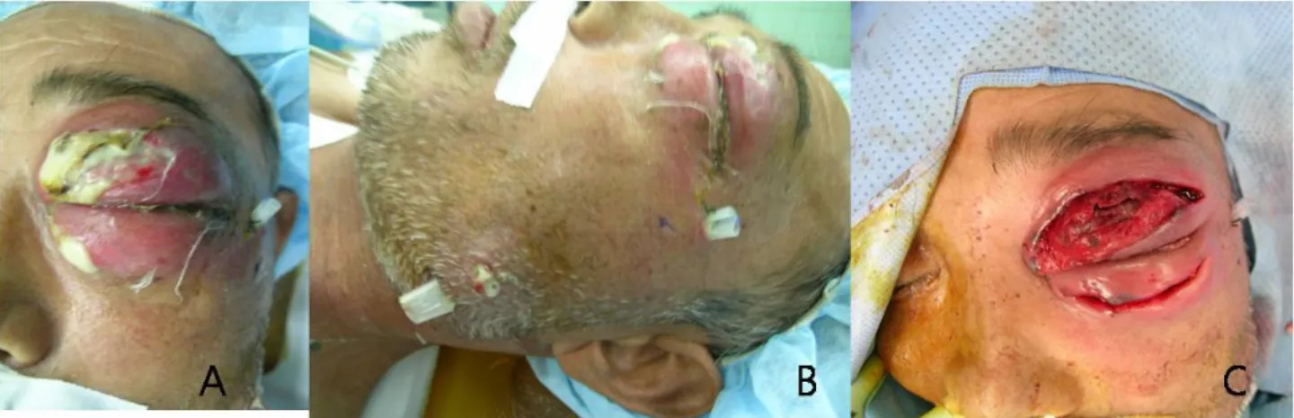 Figure 4. Photograph of the patient at the operatiing room. Silastic drain tubes were inserted for drainage of pus material after  excision of necrotic tissues at the dental clinic (A: frontal view: B: lateral view)