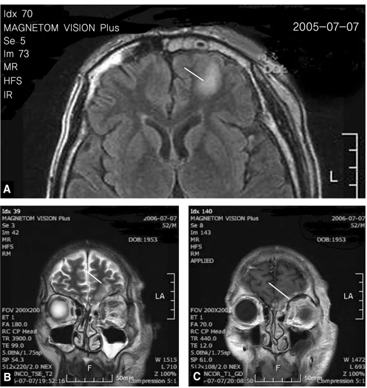 Figure 6. Brain MRI showed an ill‐defined, patchy area of a bright signal intensity on T2-weighted images (B) and a bright  signal intensity on T1-weighted images (A, C) involving the left subfrontal area (white arrows).