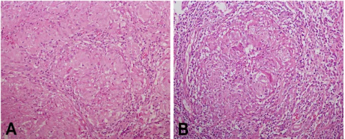 Figure 5. Histologic findings show noncaseating epitheloid granuloma and composition of epithelioid histiocytes, Langerhans'  cell and lymphocytes (H&amp;E stain, ×200).