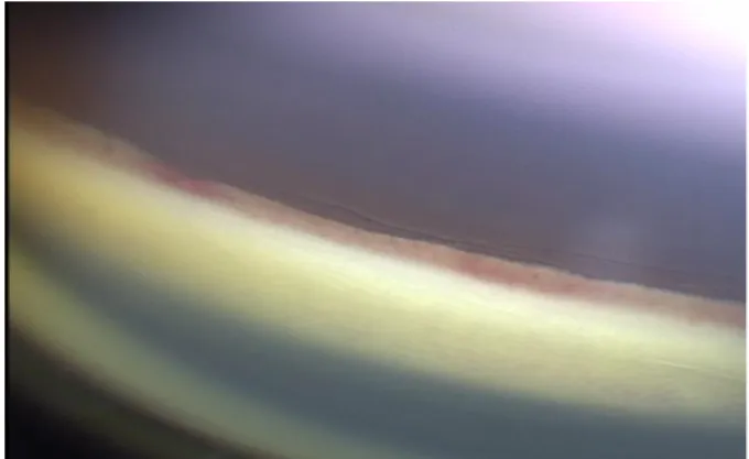 Figure 4. The anterior angle of the left eye on  postoperative 11 weeks. Note the neovascularization of the  angle.
