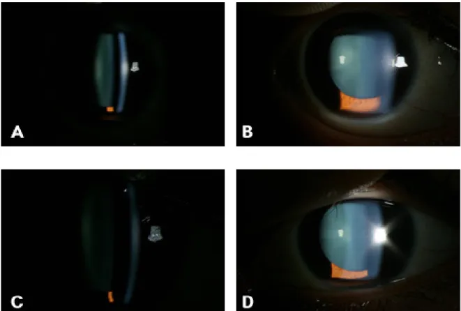 Figure 1. (Case 1) Note shallow anterior chamber (3 corneal thickness deep centrally) at initial presentation