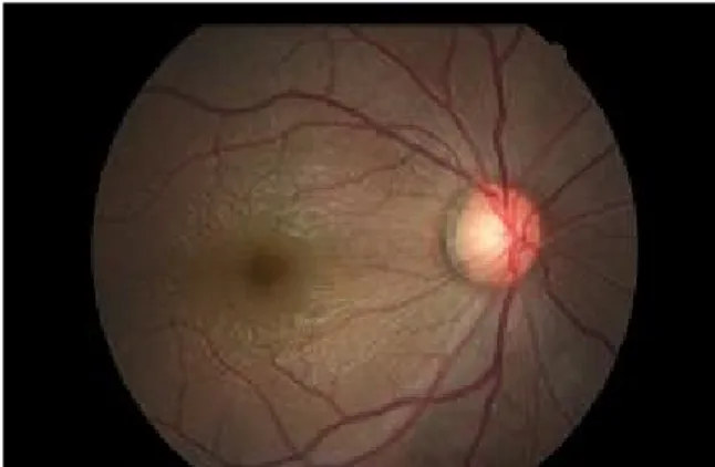 Figure 3. (Case 2) Her fundus photograph suggests no specific finding.