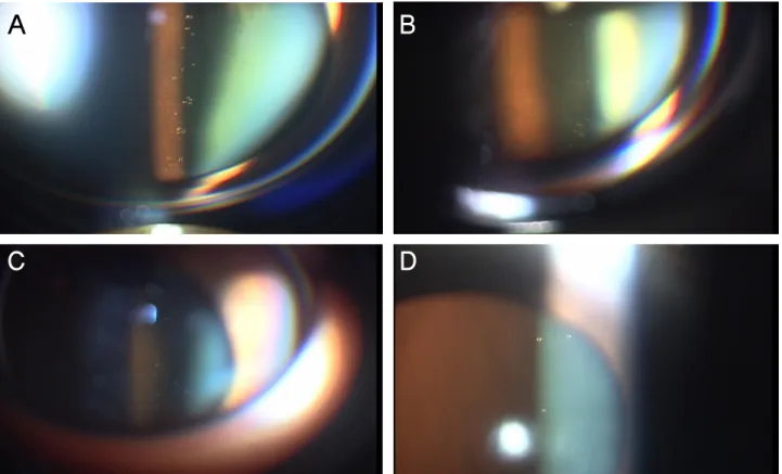 Figure 2. The clear oil-drop residues after intravitreal triamcinolone acetonide injection