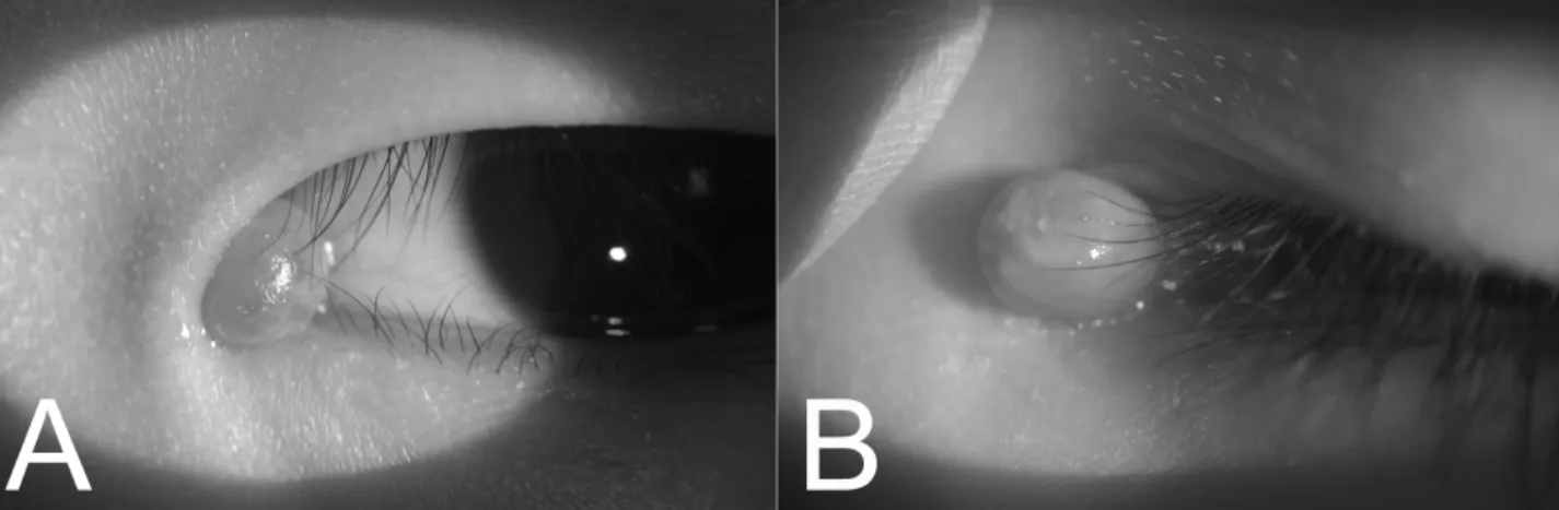 Figure 1. Photographs of the patient’s eyelid: (A, B) Note a relatively large (7×5×4 mm) reddish yellow pedunculated solitary  nodule in the canthal area.