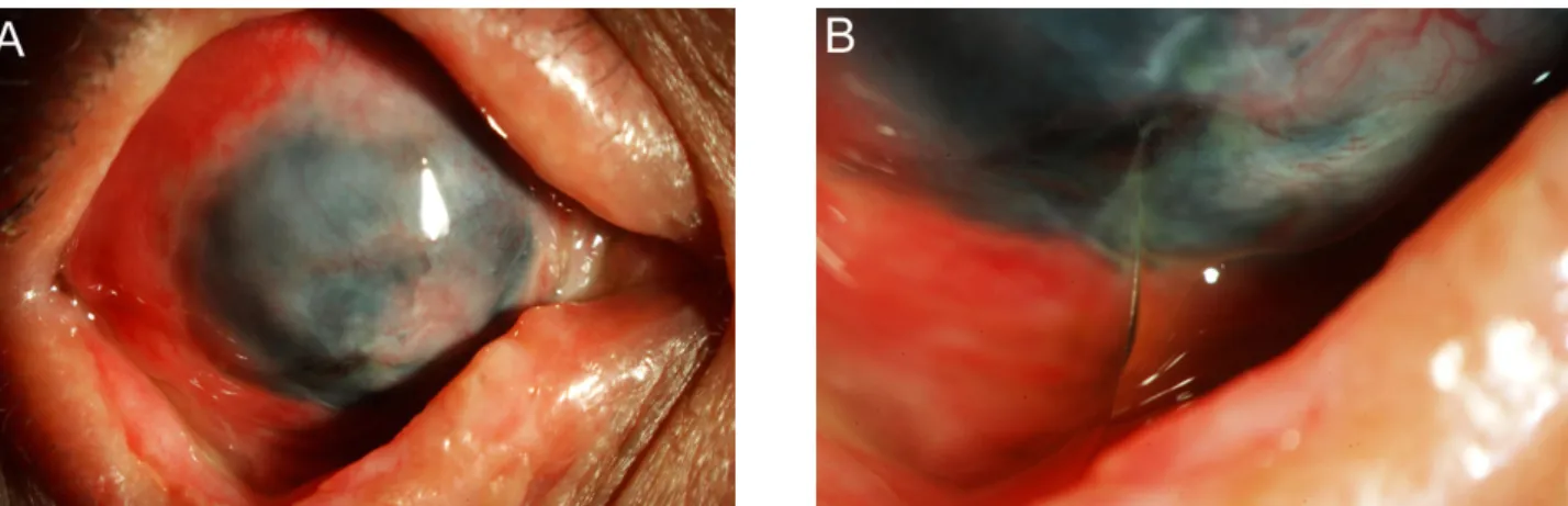 Figure 4. At six months after surgery, (A) His ocular surface was stabilized without recurrence of symblepharon