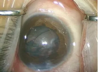 Figure 3. Slitlamp examination on the first postoperative day  reveals a slight  blue fundal glow instead of an orange  glow.