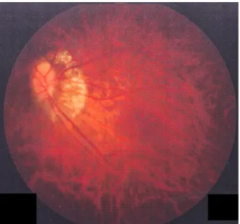 Figure 4. Fundus photograph 1 week after opeartion shows  normal red fundus reflex.