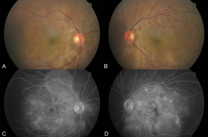Figure 1. Fundus photographs of the right eye (A) and left eye (B) showing multifocal serous retinal detachment in both eyes