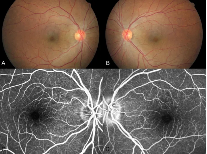 Figure 3. Fundus photographs of the right eye (A) and left eye (B). Fluorescein angiographs of the right eye (C) and left eye  (D) show flat retina without retinal elevation and dye leaking.