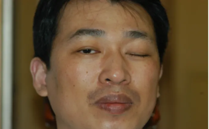 Figure 2. The patient had left face turn and he fixated with  the right eye. 