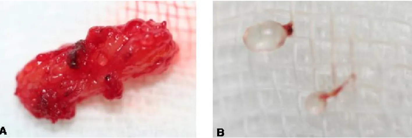 Figure 4. Gross findings of the mass. (A) The mass (14×4 mm) is not encapsulated and has irregular surface