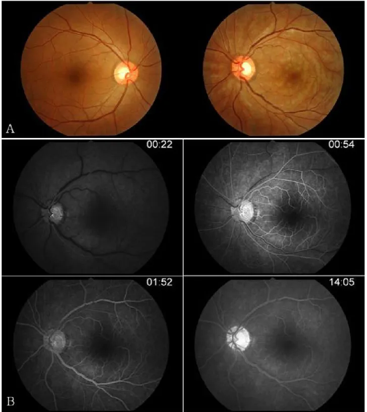 Figure 1. (A) Fundus photograph shows whitish, multiple, diffuse ischemic lesions around the posterior pole and slightly  engorged retinal veins in the left eye
