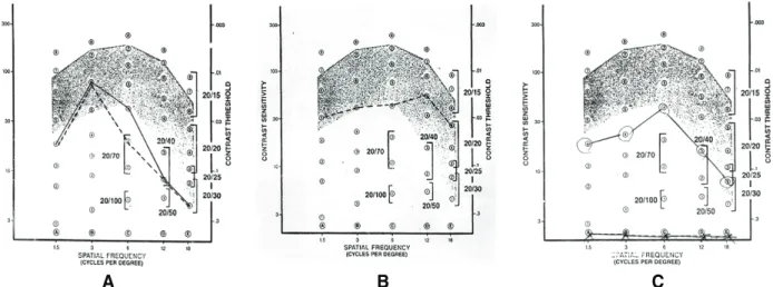 Figure 3. Contrast sensitivity test: (A) before mechanical removal of corneal deposits from LASIK interface, (B) at 2 weeks  after surgery, (C) at three and a half years after surgery (R=right eye; L=left eye; solid line=right; dotted line=left).