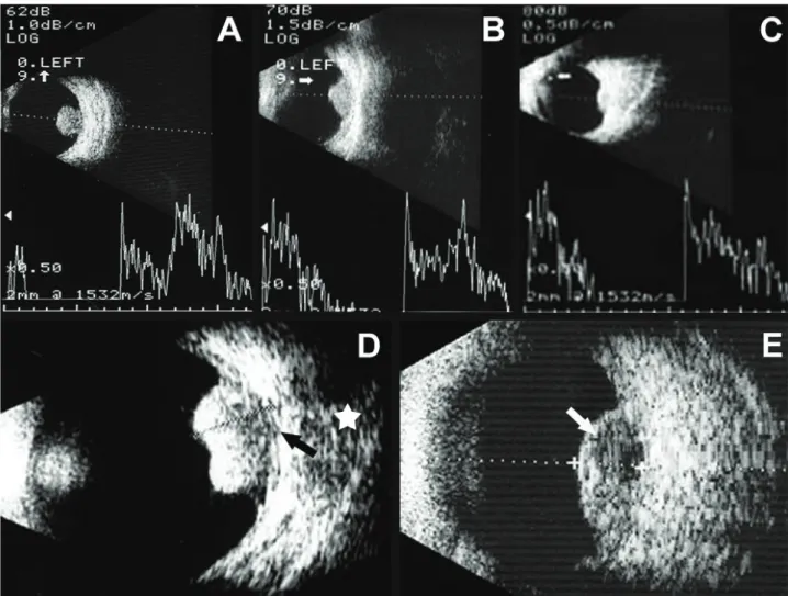 Figure 3. On CT scan, the choroidal melanoma is seen as a hyperdense lesion with moderate contrast enhancement (arrow).