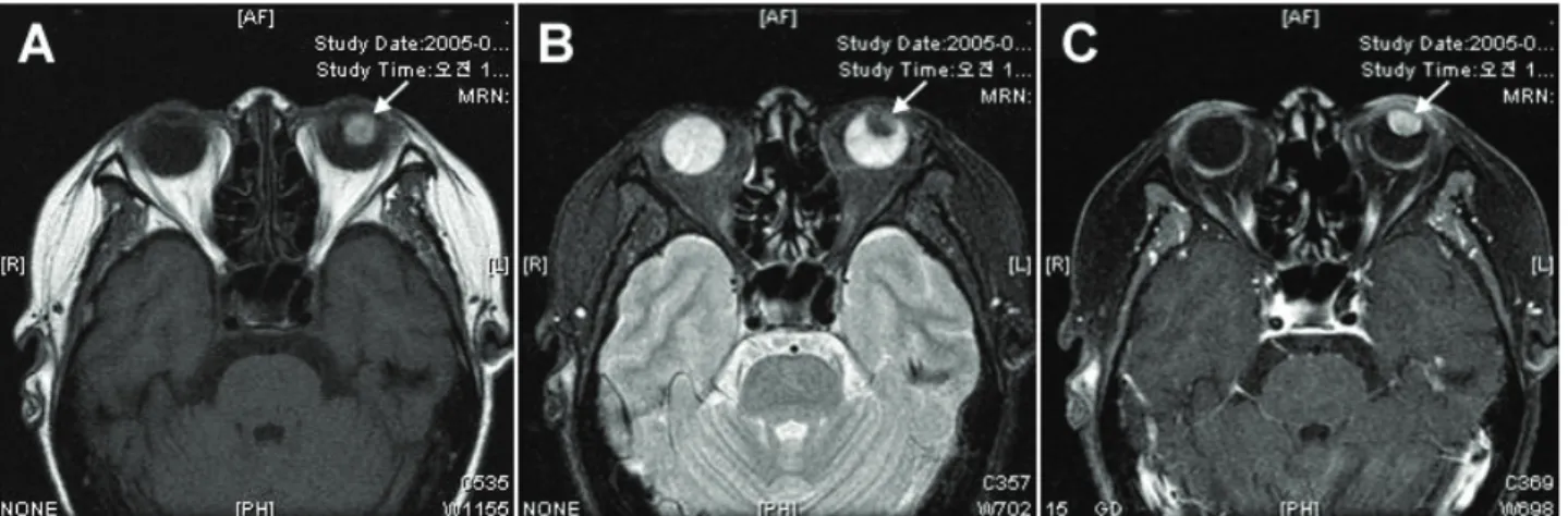 Figure 4. MRI shows that the T1-weighted image is hyperintense (arrow) (A), and the T2-weighted image is hypointense,  relatively compared to vitreous (arrow) (B)