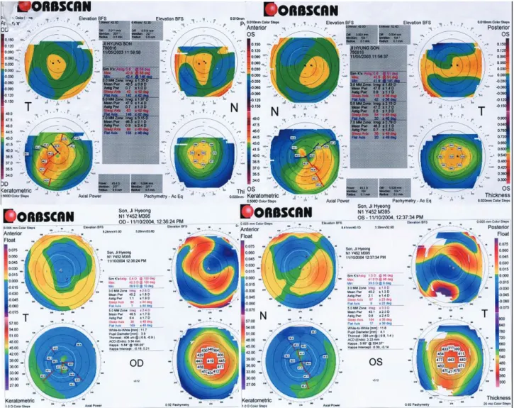 Figure 2. Orbscan showing corneal astigmatism before (upper) and 1 year after (lower) LASEK