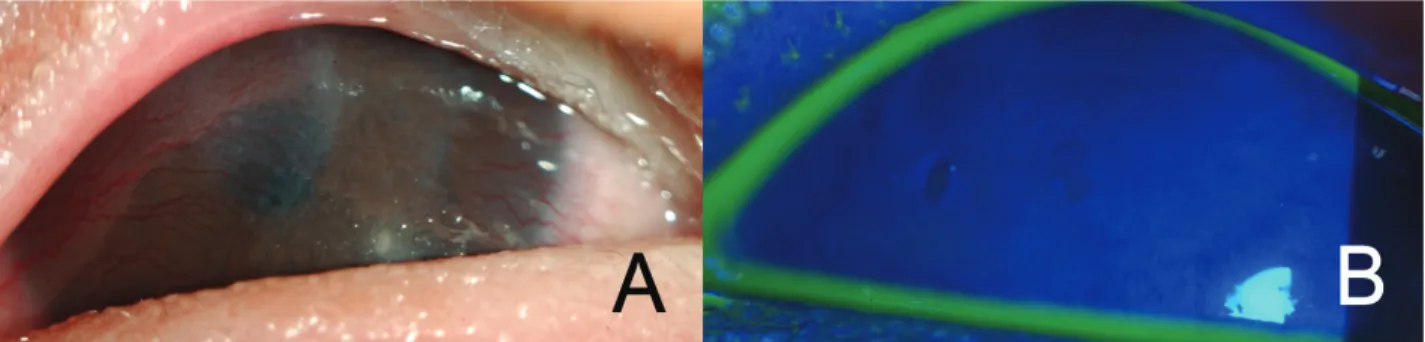 Figure 3. Slit lamp photographs of right eye after surgery. Lamellar keratectomy and amniotic membrane transplantation were  done