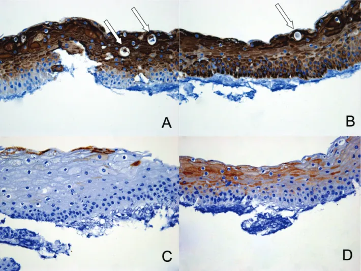 Figure 5. Immunohistochemical staining for cytokeratin of the corneal lesion of KID syndrome