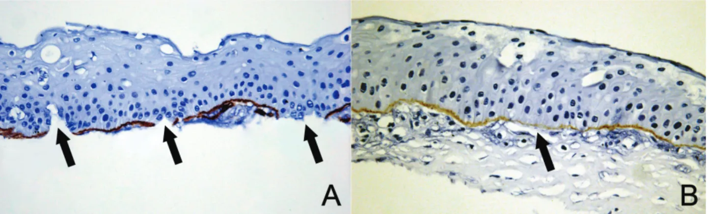 Figure 7. Immunohistochemical staining for basement membrane of the corneal lesion of KID syndrome