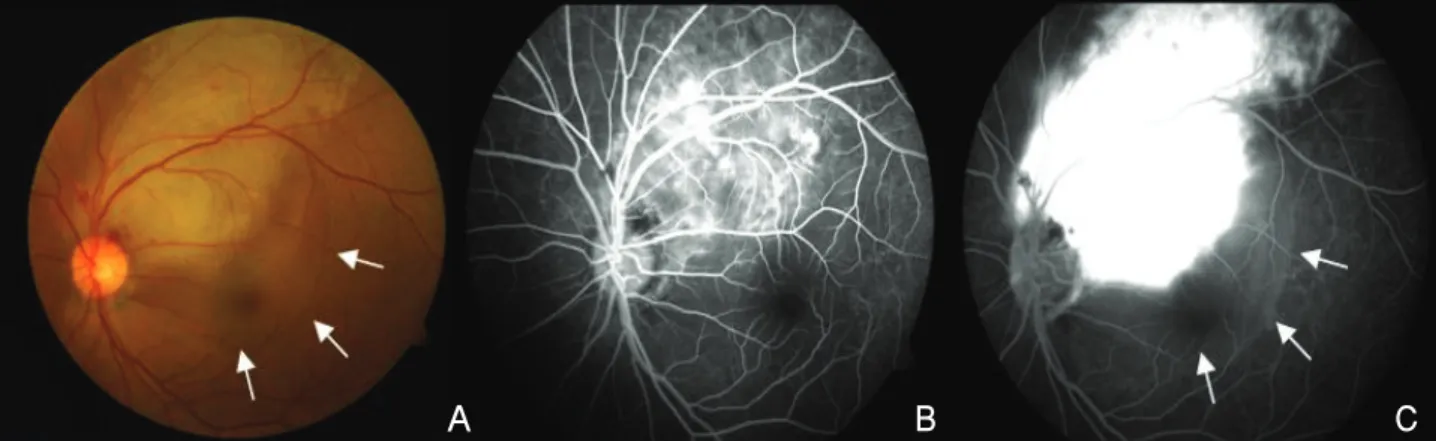 Figure 2. (A) Optical coherence tomographd emonstrates subretinal fluid associated with retinal contusion 3 days after blunt  trauma