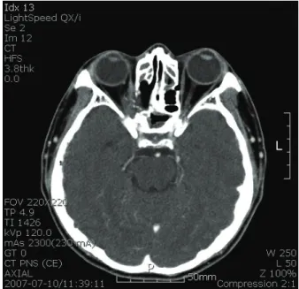 Figure 1. Computed tomograph shows tumor infiltration of  the orbit with molding to orbital contour.