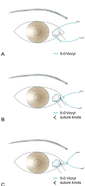 Figure 1. (A) A double-armed 5-0 Vicryl suture was passed  through the conjunctiva and Tenon’s capsule just lateral to  the collar of the tube, which was repeated with 3 bites