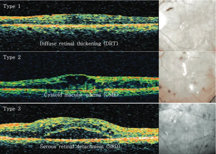 Figure 1. The classification of clinically significant diabetic macular edema by OCT features